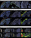 Progression of CD8+ T cell exclusion during the formation of tumor immune d