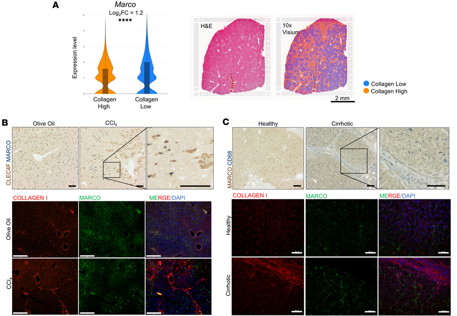 MARCO+ macrophages are increased in chronic liver fibrosis but localize ...