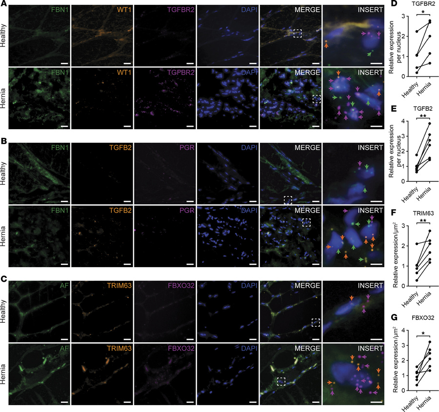 Increased expression of TGF-β pathway–related genes and myofiber atrophy...