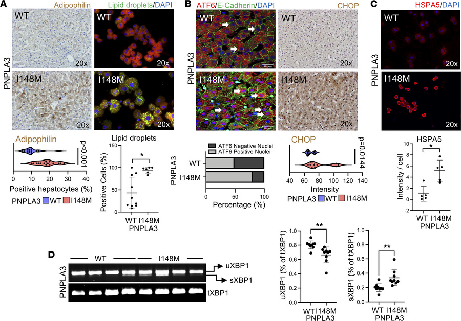 The PNPLA3-I148M mutation leads to intracellular lipid accumulation and ...