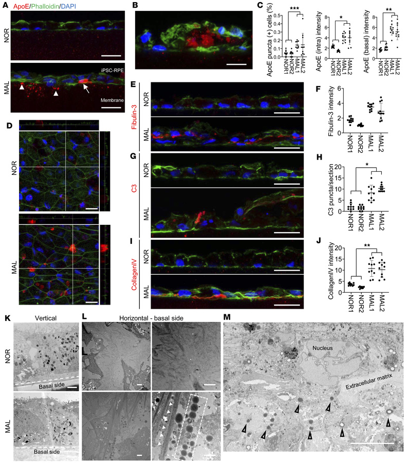 Formation of drusen-like accumulation beneath MAL iPSC-RPE cells.
iPSC-R...
