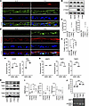 Apoptosis and extracellular matrix degradation in MAL iPSC-RPE cells.