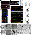Formation of drusen-like accumulation beneath MAL iPSC-RPE cells.