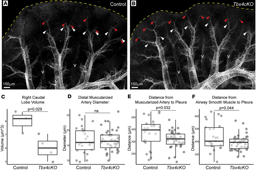 Decreased distance between muscularized airways and arteries and the ple...