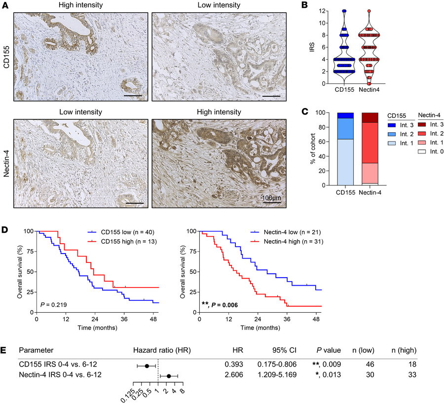 Nectin-4 expression is associated with poor outcome in PDAC.
(A) Represe...