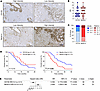 Nectin-4 expression is associated with poor outcome in PDAC.