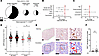BKV reactivation, outcome, and renal CD8+ T cell accumulation in kidney tra