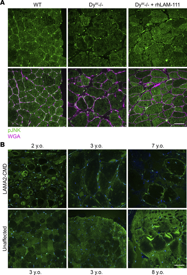 Cytosolic localization of p-JNK in dyW–/– and LAMA2-CMD skeletal muscle....