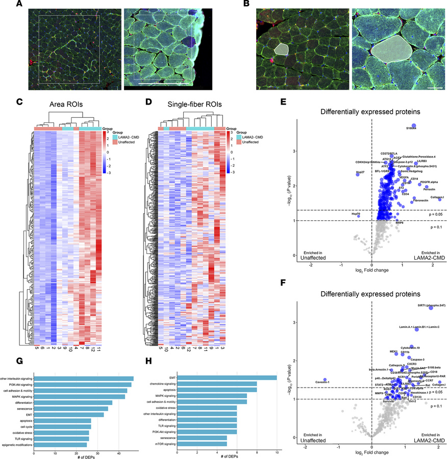 Spatial profiling reveals large-scale changes in LAMA2-CMD patient muscl...