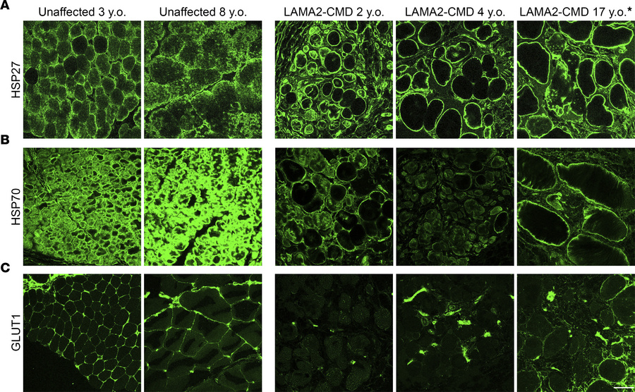 Patients with LAMA2-CMD exhibit altered localization of downregulated DS...