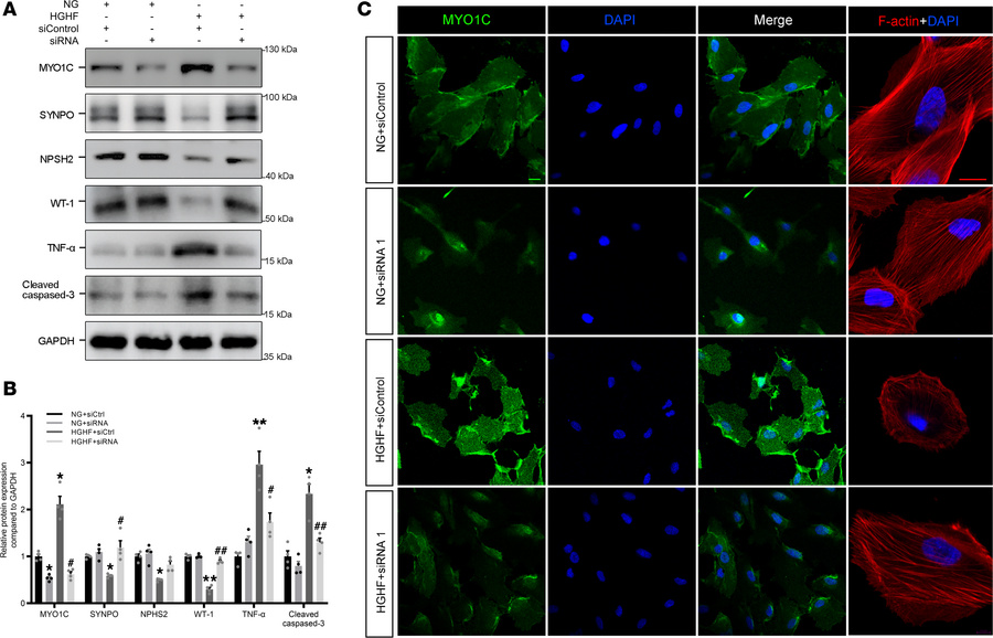 The protective effect of knockdown against HGHF-induced podocyte injury....