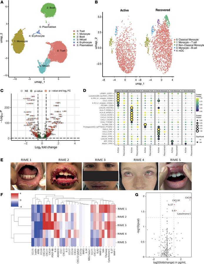Clinical and inflammatory profiling of 5 patients with RIME.
(A) UMAP vi...