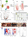 Clinical and inflammatory profiling of 5 patients with RIME.