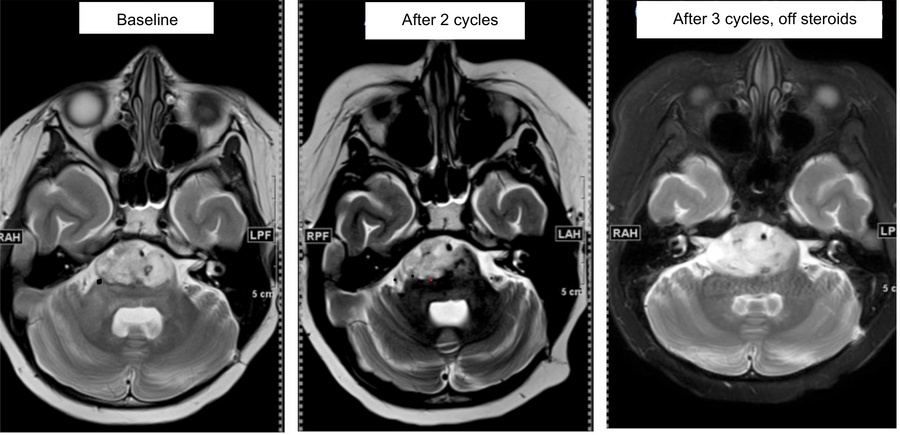 Radiographic tumor response to WP1066 treatment.
Serial brain MRIs from ...