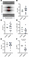 Myofilament and myosin order in patients with XLMTM.
