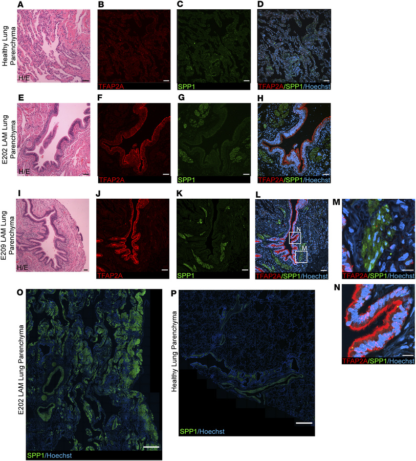 Evidence of neurocristopathy in LAM pulmonary neoplasms (SPP1 and TFAP2A...