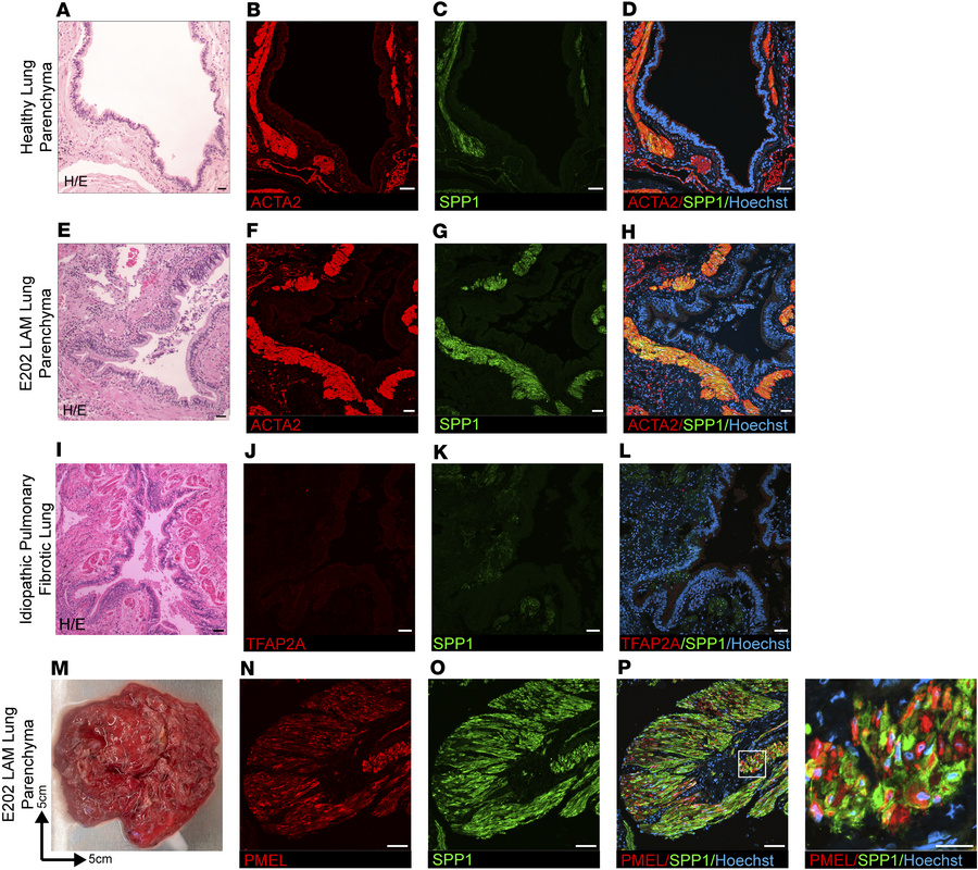 Evidence of neurocristopathy in LAM pulmonary neoplasms (SPP1 and ACTA2,...