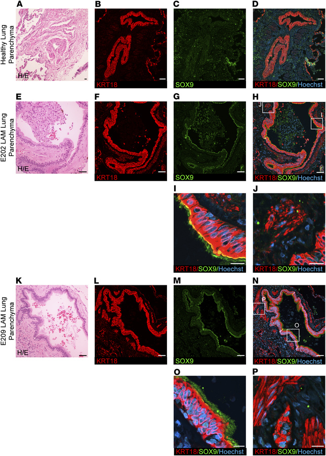 Evidence of neurocristopathy in LAM pulmonary neoplasms (KRT18 and SOX9)...