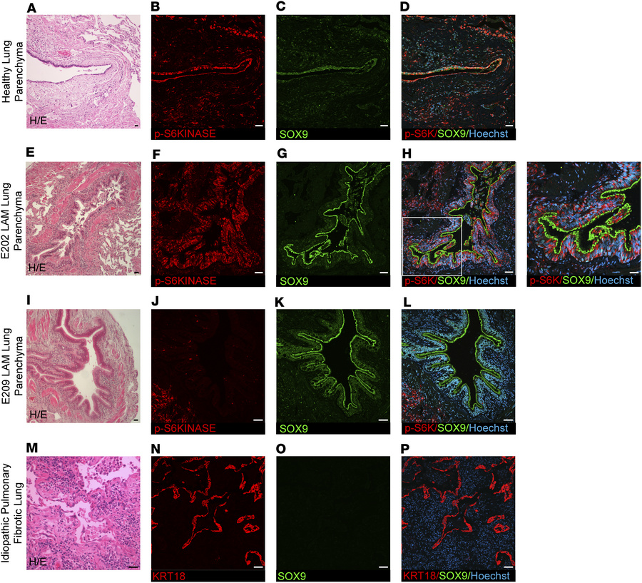 Evidence of neurocristopathy in LAM pulmonary neoplasms (SOX9 and p-S6K)...