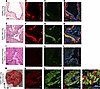 Evidence of neurocristopathy in LAM pulmonary neoplasms (SPP1 and ACTA2, PM