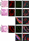 Evidence of neurocristopathy in LAM pulmonary neoplasms (KRT18 and SOX9).