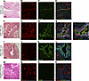 Evidence of neurocristopathy in LAM pulmonary neoplasms (SOX9 and p-S6K).