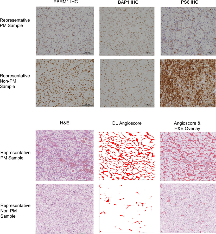 Illustrative images of pancreatic and nonpancreatic metastases.
Represen...