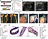 Ptk2 deletion in SMC worsens TAA development in a gene dosage–dependent man