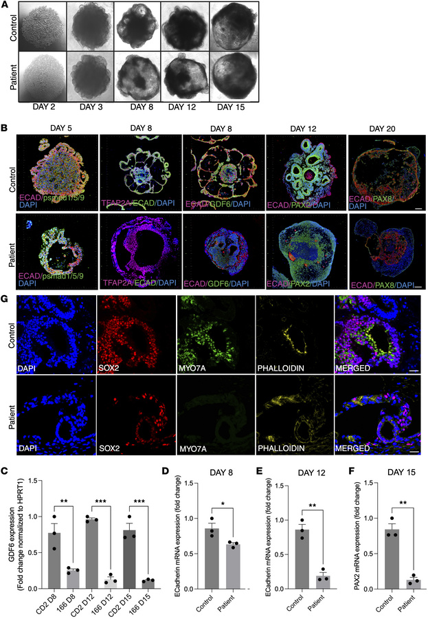 A putative GDF6 enhancer lesion impairs otic organoid development and ha...