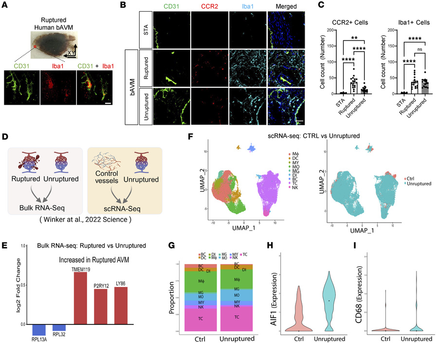 Human bAVMs display the presence of MG/Mϕ in bAVM territories.
(A) A rup...