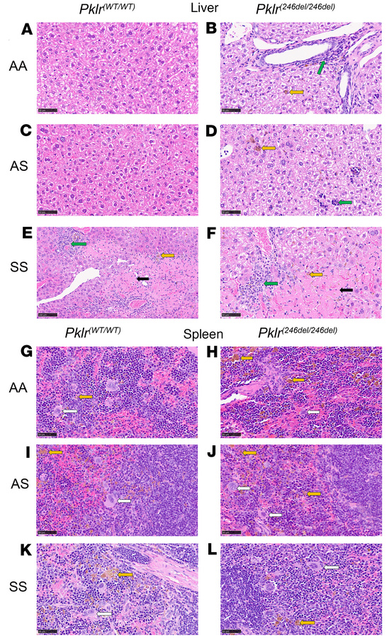 Coinheritance of Pklr-null mutations [Pklr(13ntdel/13ntdel) or Pklr(246n...