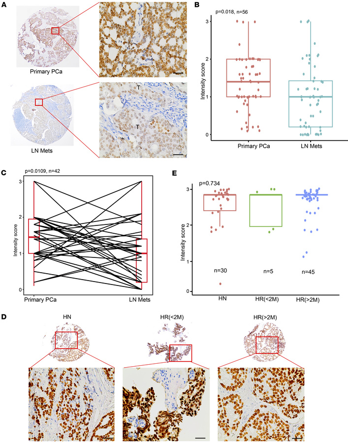 HOXB13 is downregulated in metastatic hormone-sensitive prostate cancer....