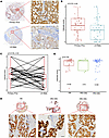 HOXB13 is downregulated in metastatic hormone-sensitive prostate cancer.
