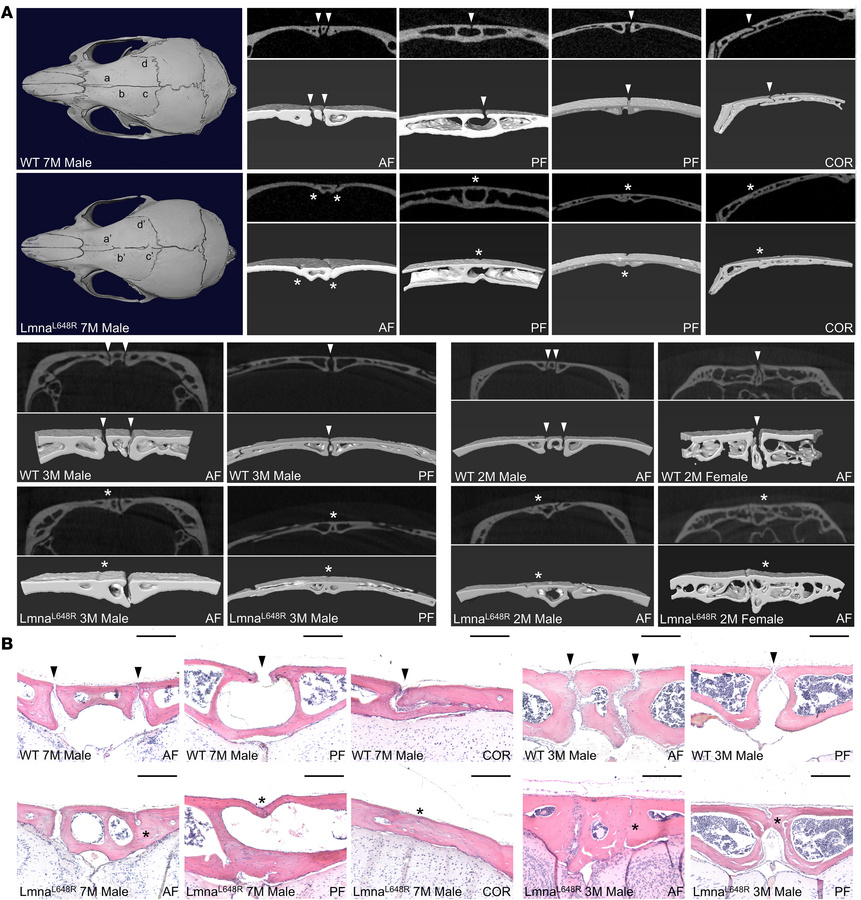 Multiple suture synostosis caused by LmnaL648R mutation.
(A) Representat...