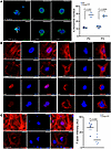 Cytoskeletal disruption by the progeroid accumulation of prelamin A.