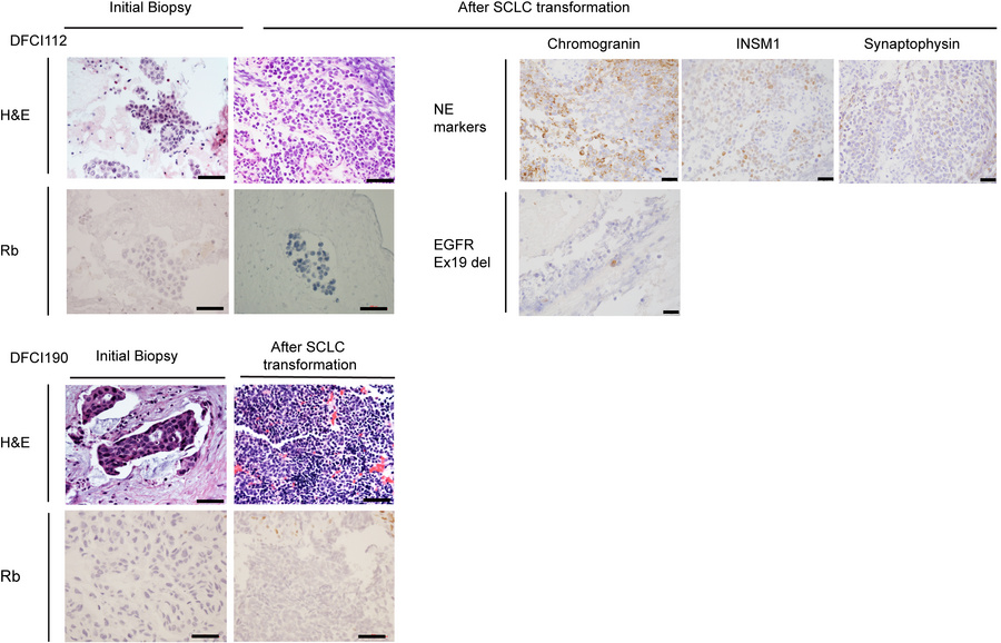 The matched pre- and posttreatment lung biopsies reveal a transformation...