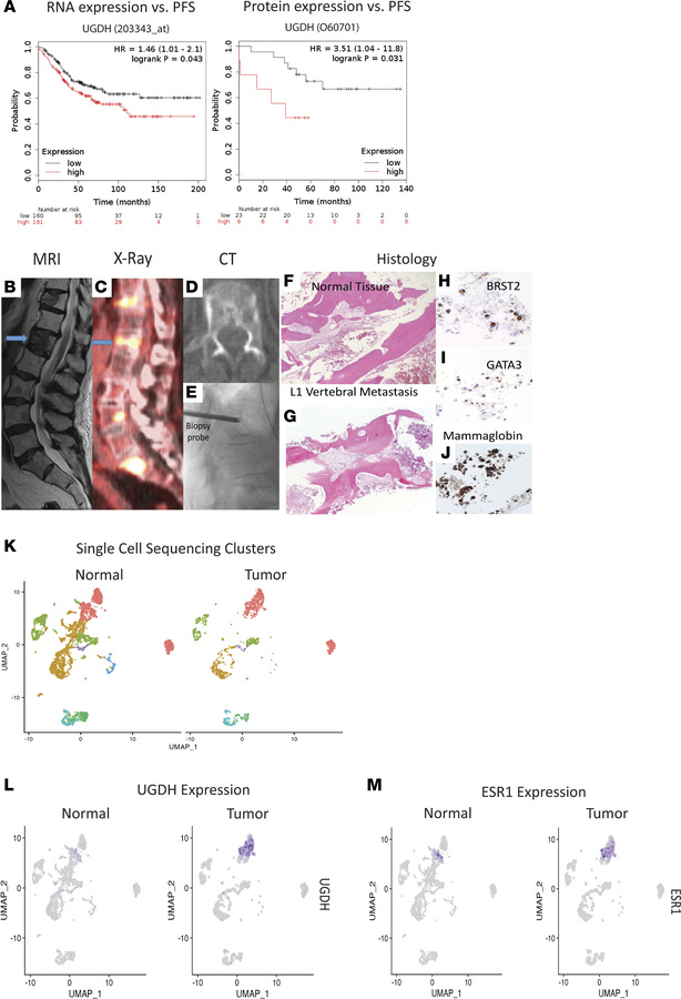 UGDH as a prognostication marker for patient survival and patients with ...