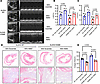 Aldh2 overexpressing rescues worsened cardiac function induced by Aldh2 rs6