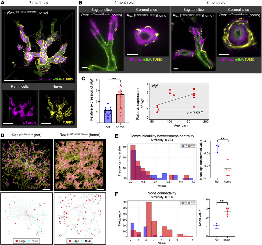 Renin enzymatic insufficiency leads to overstimulation of renin cells, N...