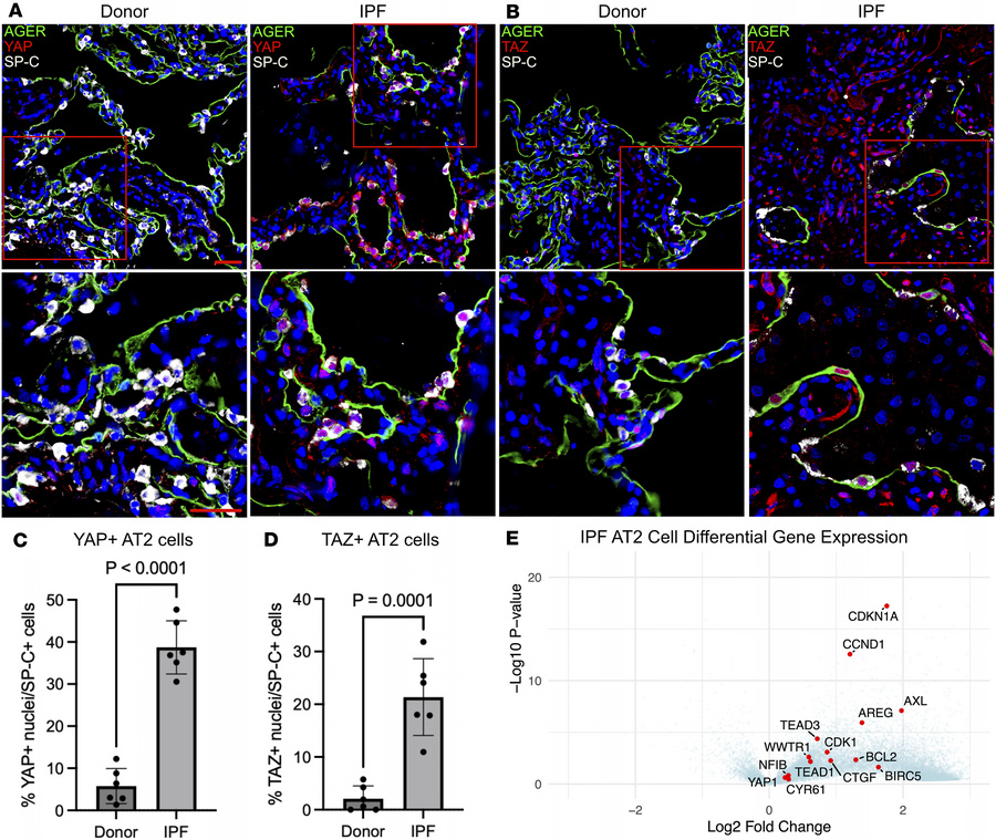 YAP and TAZ are active in the IPF epithelium.
(A and B) Immunofluorescen...