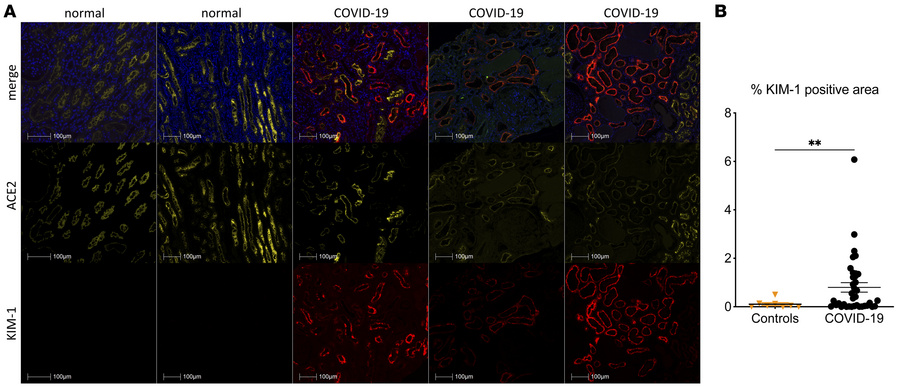 KIM-1 expression in kidneys of patients with COVID-19.
(A) Representativ...