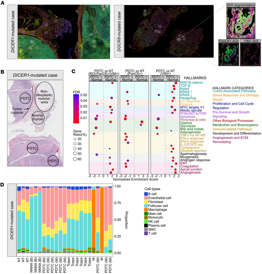 Transcriptomic profiles of a DICER1 thyroid lesion.
(A) Immunofluorescen...