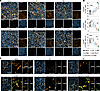 Multiplex immunofluorescence analysis of tumor tissues following UTMC combi