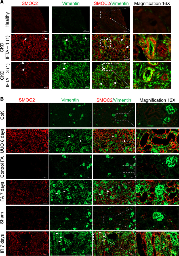 SMOC2 localization is associated with tubular cells undergoing pEMT in p...