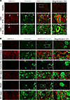 SMOC2 localization is associated with tubular cells undergoing pEMT in pati