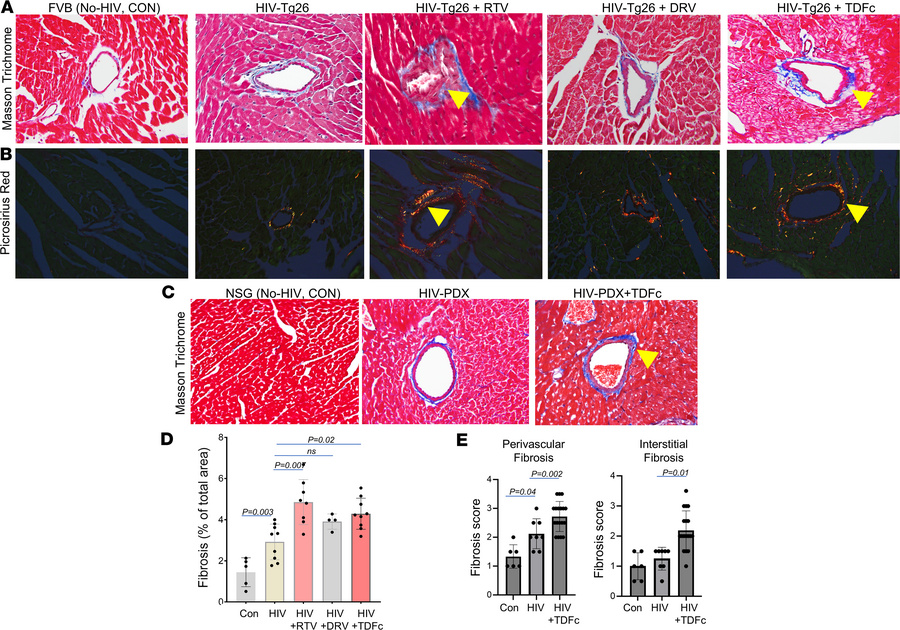 Effect of ART on cardiac fibrosis in HIV mice.
(A) Representative images...
