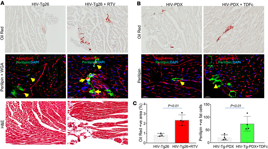 ART-induced ectopic fat deposition in the heart is associated with cardi...