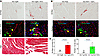 ART-induced ectopic fat deposition in the heart is associated with cardiac