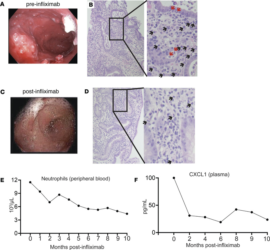 Clinical response to TNF antagonism in patient CA01 corresponds with res...