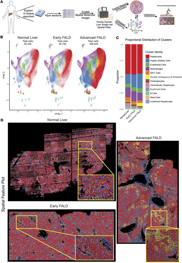 Single-cell spatial transcriptomic atlas of human FALD with early and ad...